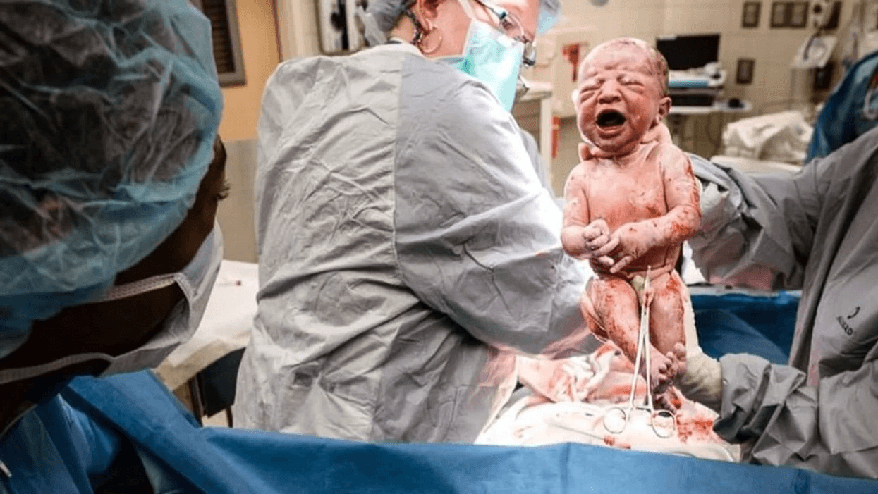 c section picture showing baby being delivered after surgery