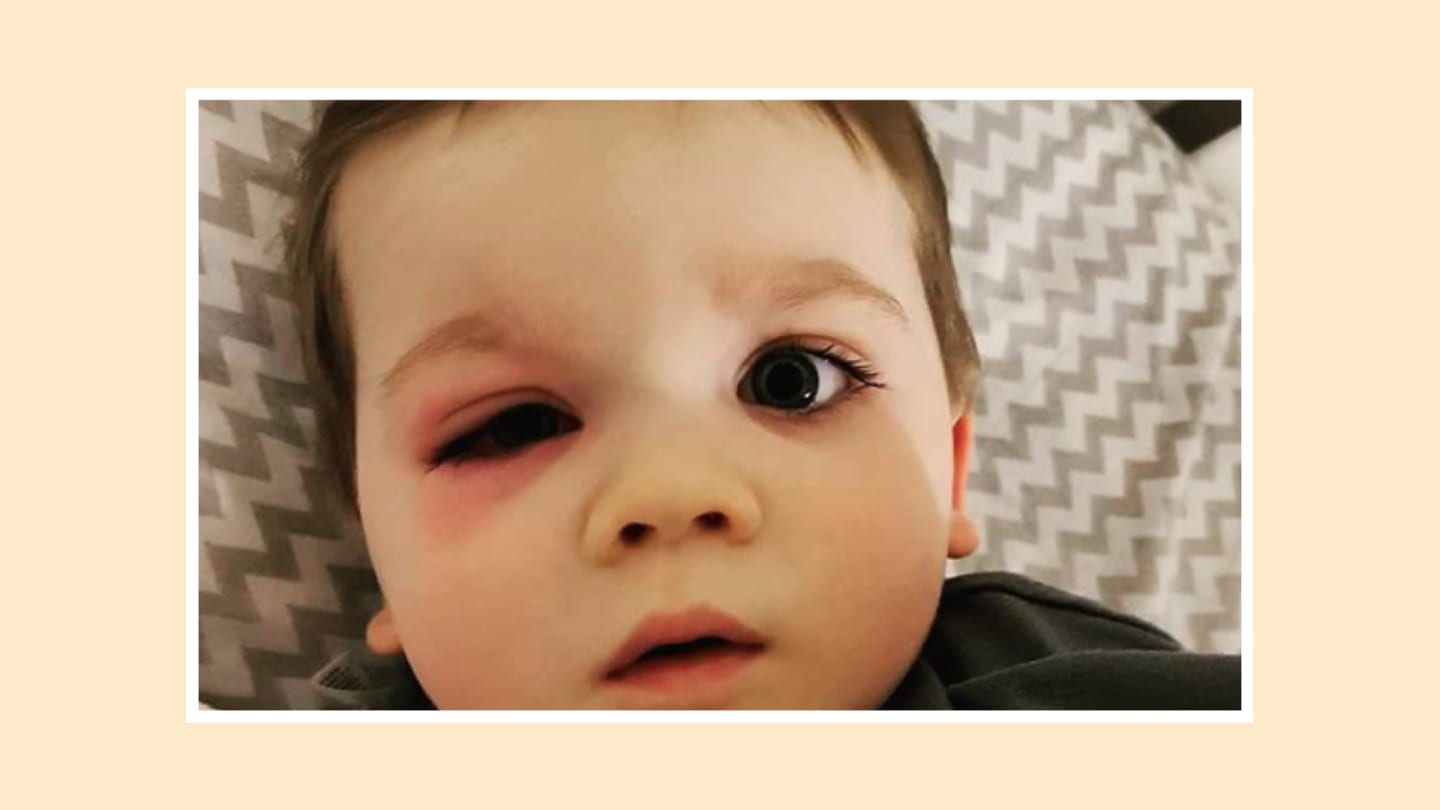 baby gets eye infection from bath toys