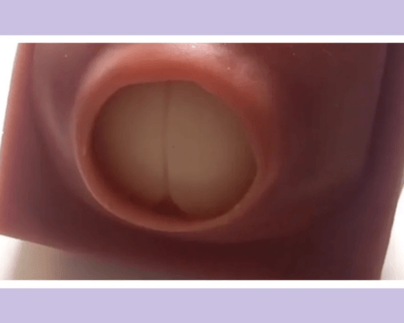 cervix dilating