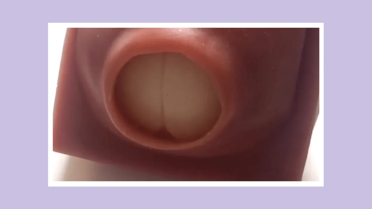 image of a cervix dilating