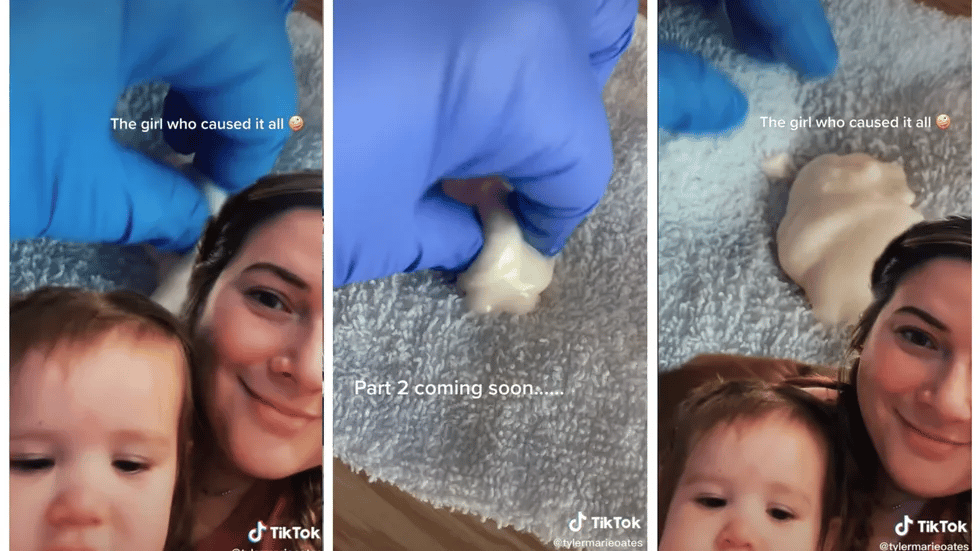 Don't Freak Out About That Viral 'Milk Duct' Image, It's Not