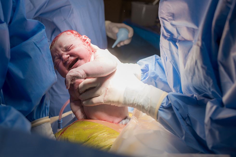 C-section moms experience