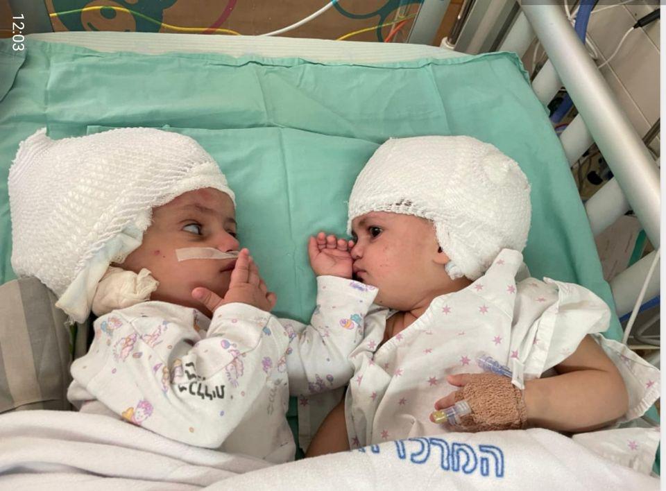 Conjoined Twins Pregnant