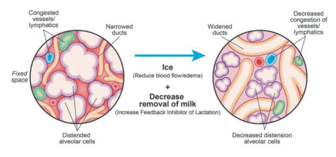 New ABM Mastitis Guidelines Urge Ice Over Heat - Motherly