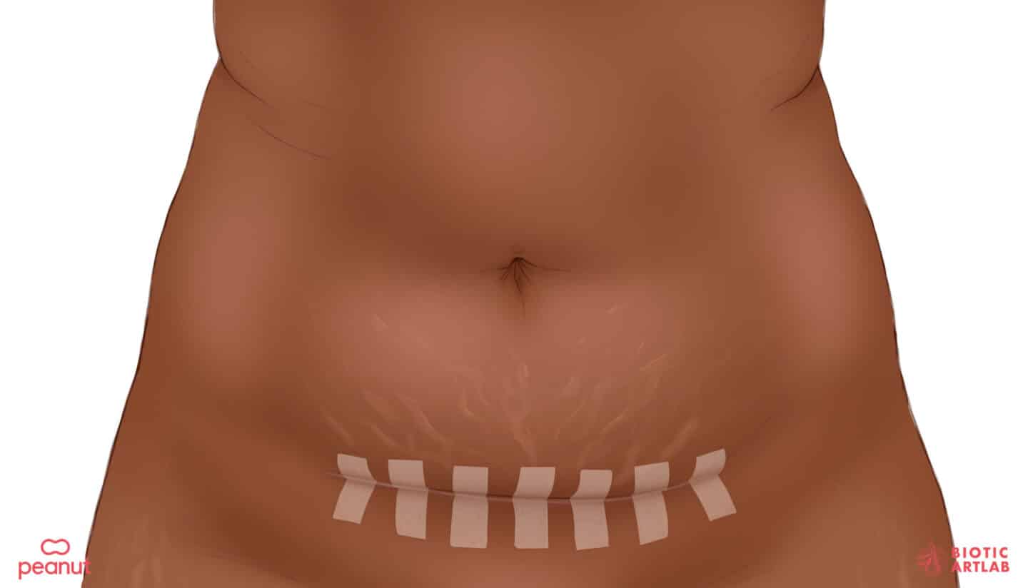 Picture of a C-section scar after surgery, answering the question what happens during a c-section?