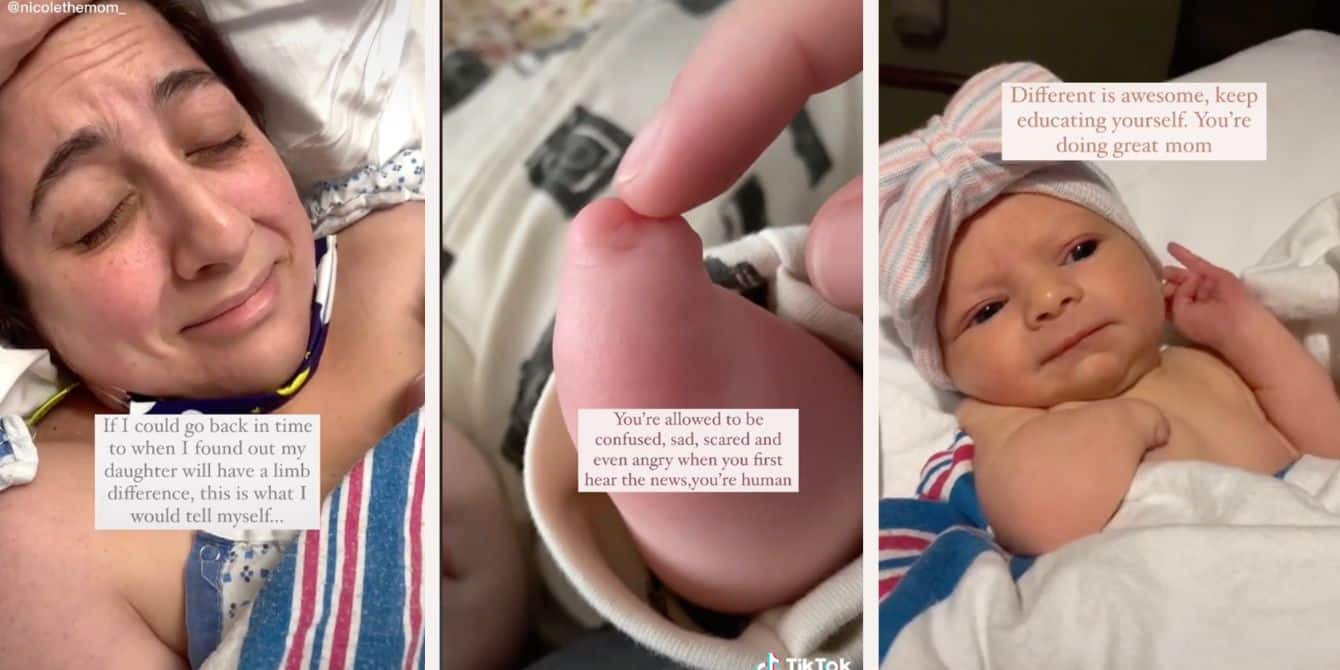 Viral TikTok of mom celebrating baby's limb difference