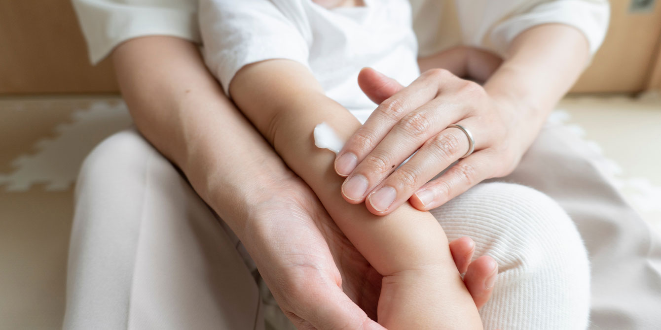 parent putting cream on baby's skin in eczema treatments for kids