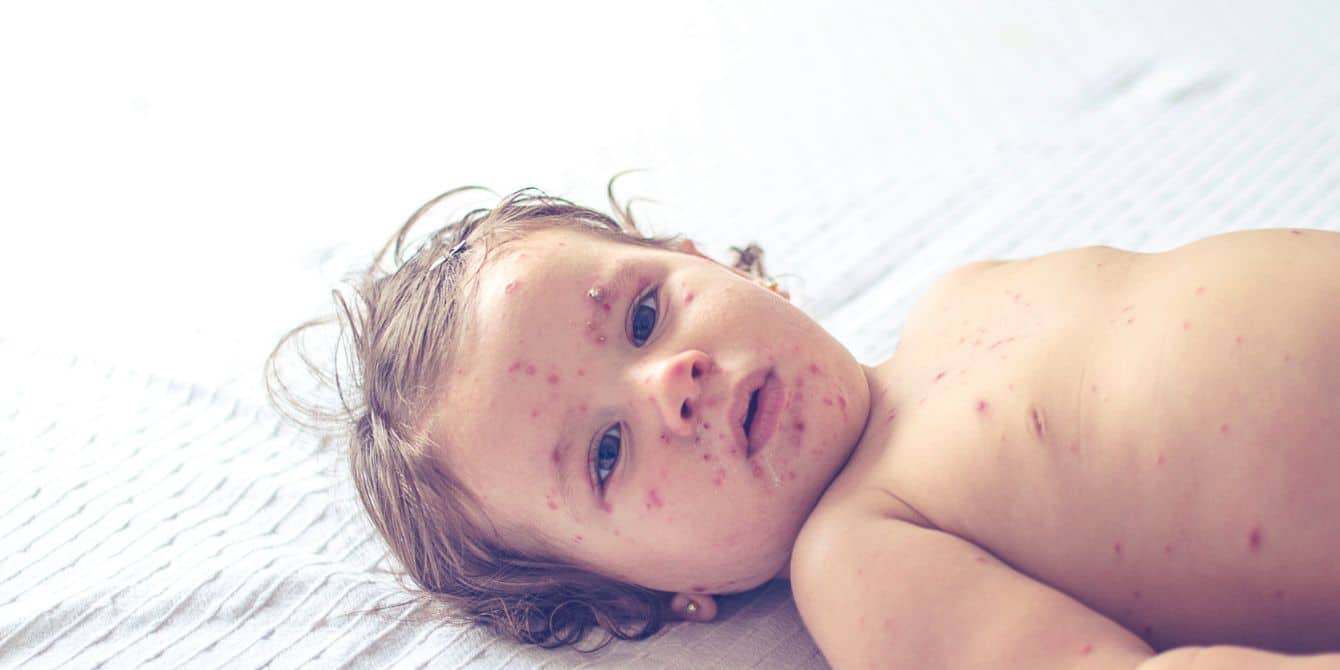 Little girl with measles