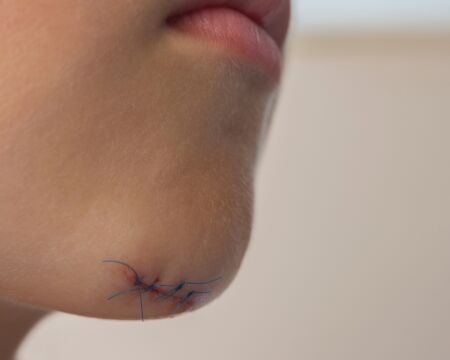 child with stitches on chin Motherly