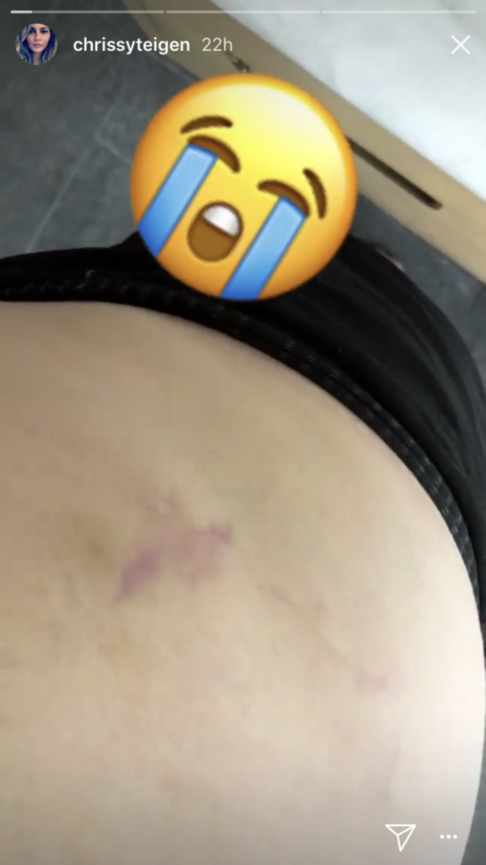 chrissy teigens reaction to her new stretch marks is complicated real 0 Motherly